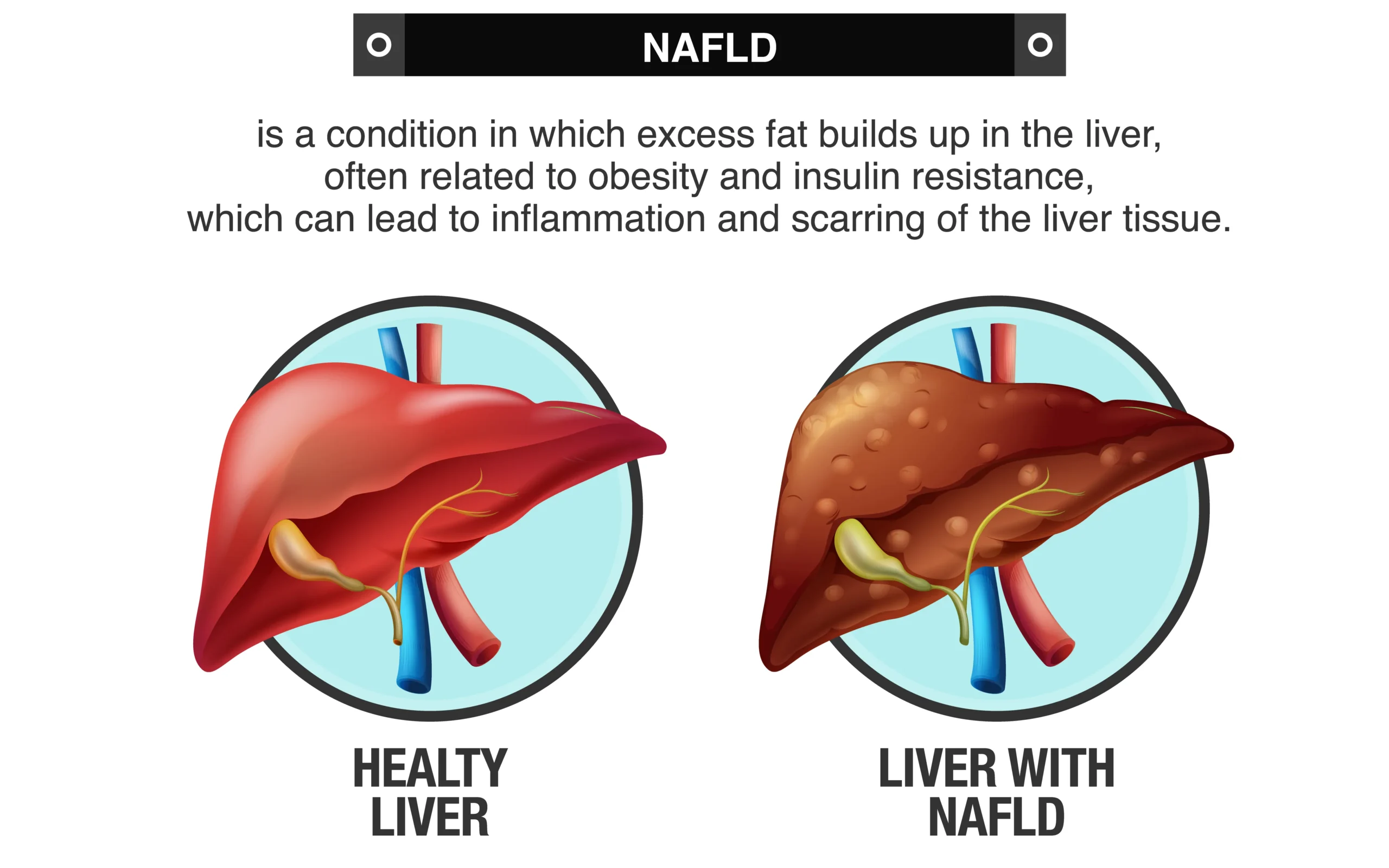 nafld